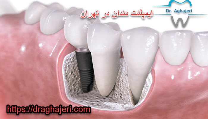 ایمپلنت دندان در تهران