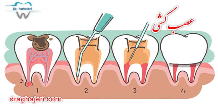 عصب کشی دندان