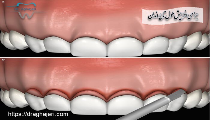 جراحی افزایش طول تاج دندان چگونه انجام می شود ؟