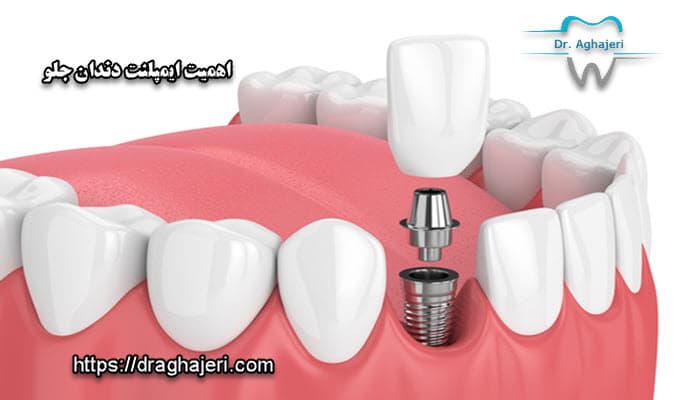 اهمیت ایمپلنت دندان جلو در چیست؟