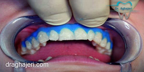  مراقبت‌های لازم برای ماندگاری بیشتر بلیچینگ دندان
