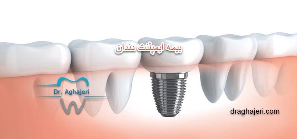 بیمه ایمپلنت دندان