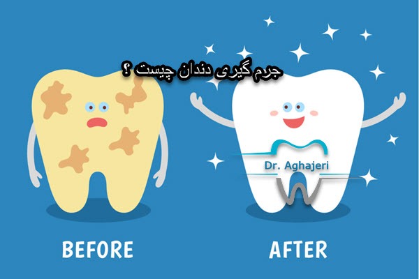 جرم گیری دندان چیست ؟