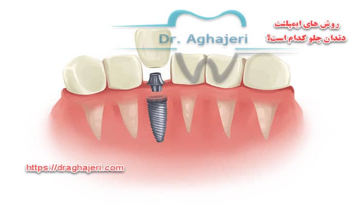 روش های ایمپلنت دندان جلو کدام است؟
