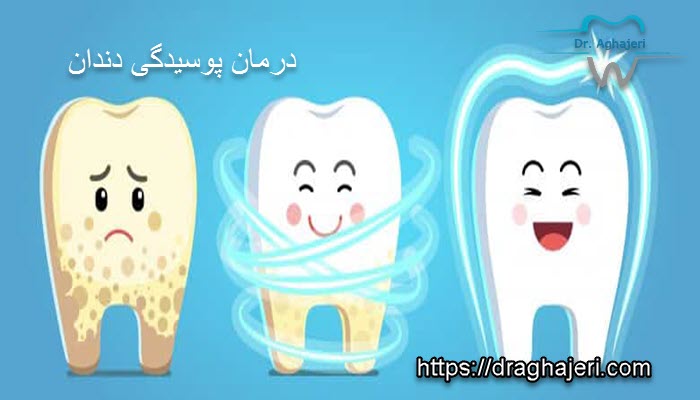 علت پوسیده شدن دندان چیست؟