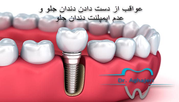 عواقب از دست دادن دندان جلو و عدم ایمپلنت دندان جلو