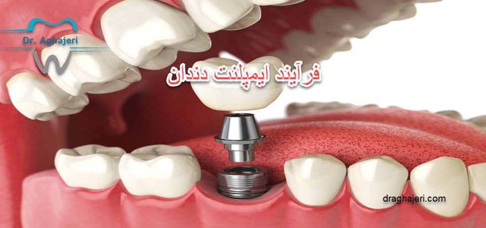 فرآیند ایمپلنت دندان