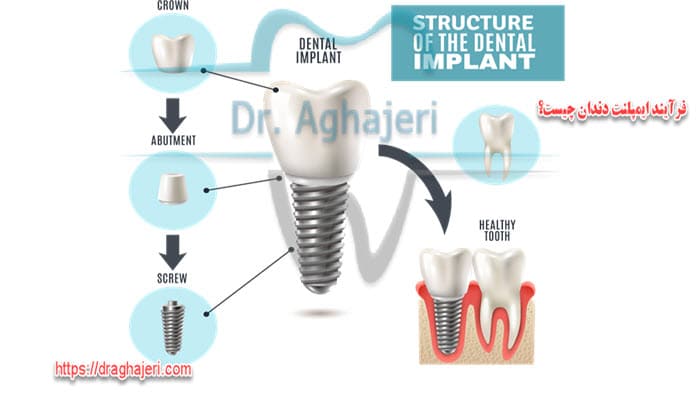 فرآیند ایمپلنت دندان چیست؟