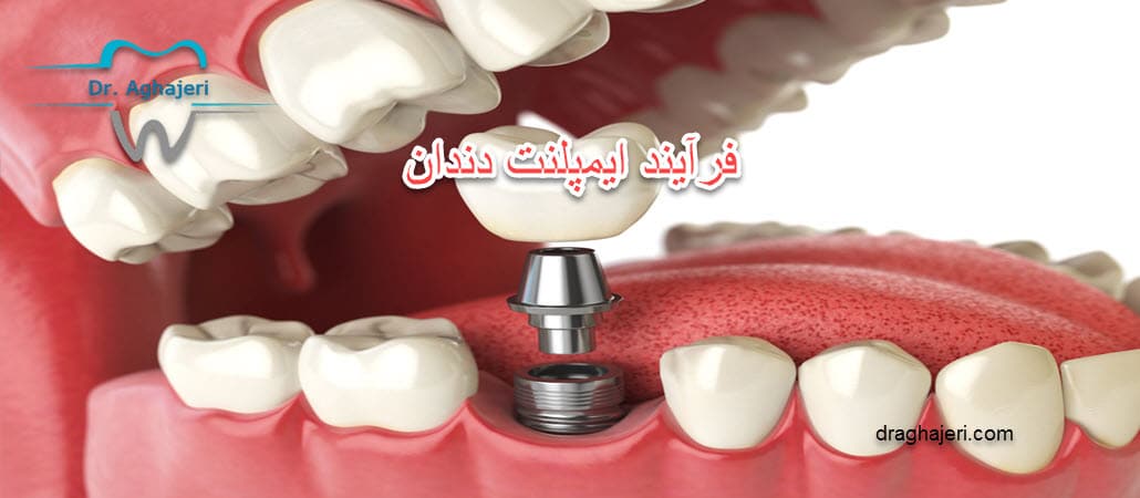 فرآیند ایمپلنت دندان