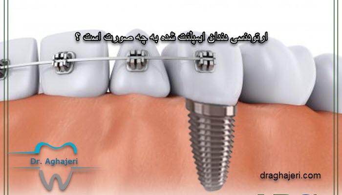 ارتودنسی دندان ایمپلنت شده به چه صورت است ؟