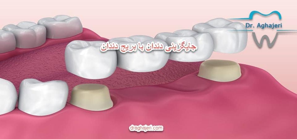 جایگزینی دندان با بریج دندان