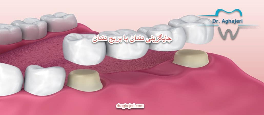 جایگزینی دندان با بریج دندان