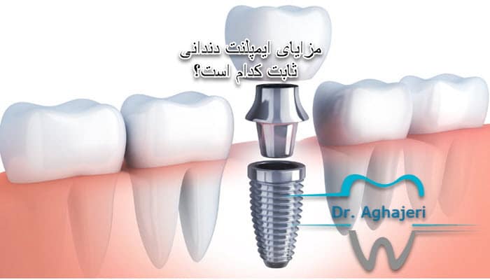 مزایای ایمپلنت دندانی ثابت کدام است؟