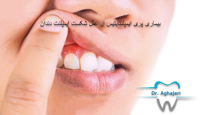 بیماری پری ایمپلنتایتیس از علل شکست ایمپلنت دندان