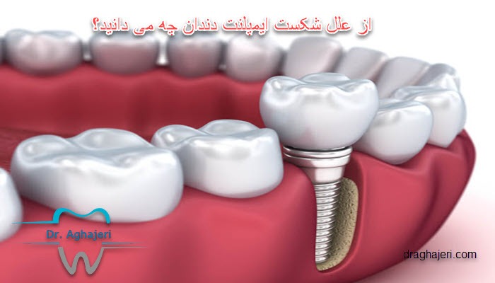 از علل شکست ایمپلنت دندان چه می دانید؟