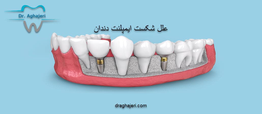 علل شکست ایمپلنت دندان