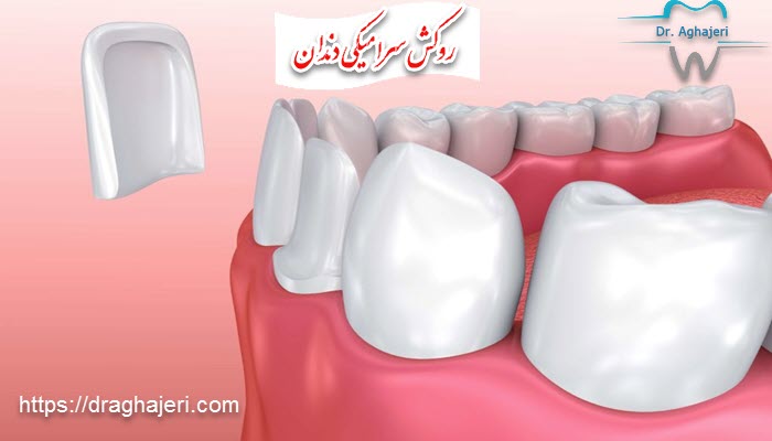 ویژگی روکش تمام سرامیکی دندان چیست؟