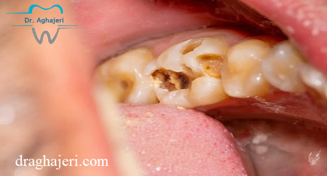 علت پوسیده شدن دندان چیست؟