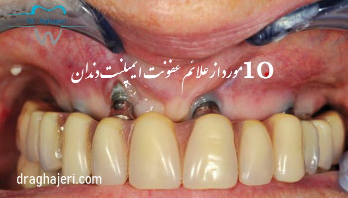 10 مورد از علائم عفونت ایمپلنت دندان