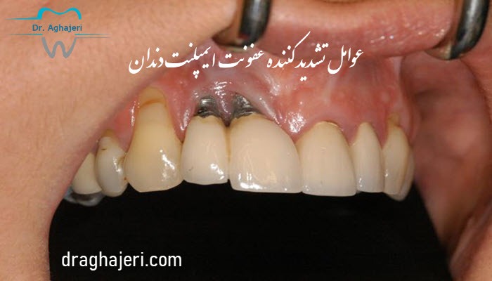 عوامل تشدید کننده عفونت ایمپلنت دندان