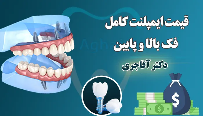 قیمت ایمپلنت کامل فک بالا و پایین